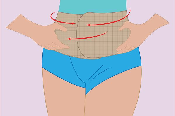 Complications of abdominal girdle closure