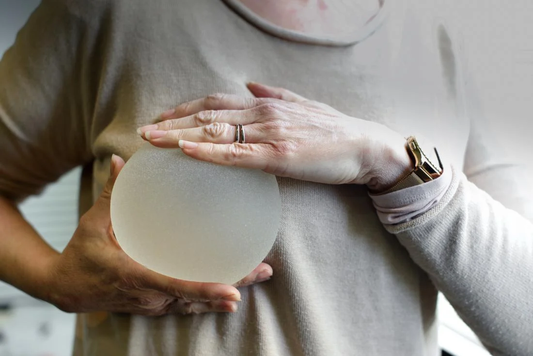 Complications of delayed breast implant suture removal