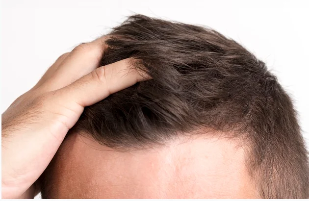 Home remedies for hair loss for men and women